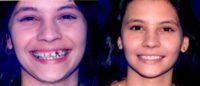 18-24 year old woman treated with Smile Makeover
