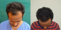 18-24 year old man treated with Hair Transplant