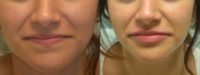 18-24 year old woman treated with Restylane