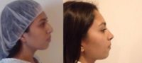 18-24 years old woman rhinoplasty