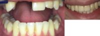18-24 year old man treated with Dental Crown