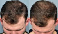 18-24 year old man treated with Hair Loss Treatment