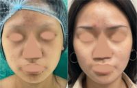 18-24 year old woman treated with Buccal Fat Removal