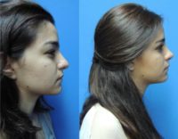 18-24 year old woman treated with Rhinoplasty