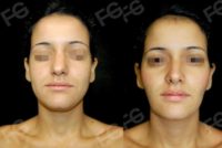 22 year old woman treated with Rhinoplasty, Buccal Fat removal, Lip (Restylane) and neck lipo