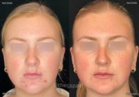 18-24 year old woman treated with AviClear