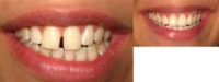 24 year old bride treated with Instant Smile Makeover with Composite Bonding.