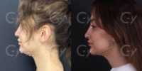 18-24 year old woman treated with Chin Liposuction