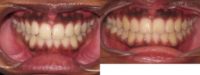 18-24 year old woman treated with Invisalign