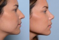 18-24 year old woman treated with Nose Surgery