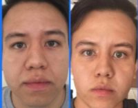25-34 year old man treated with Facelift