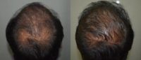 25-34 year old man treated with Derma Roller