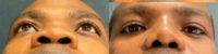 25-34 year old man treated with African American Rhinoplasty