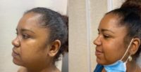 25-34 year old woman treated with Rhinoplasty