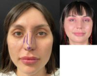 25-34 year old woman treated with Rhinoplasty