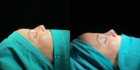 25-34 year old woman treated with Rhinoplasty