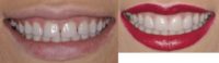 26 year old woman treated with Porcelain Veneers