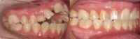 25-34 year old woman treated with Braces