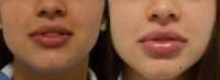 25-34 year old woman treated with Restylane