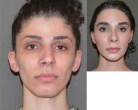 25-34 year old woman treated with Facial Feminization Surgery