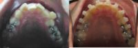 25-34 year old man treated with Damon Braces