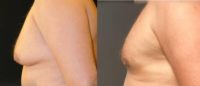 25-34 year old man treated with Gynecomastia Surgery