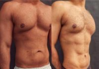 25-34 year old man treated with Liposculpture