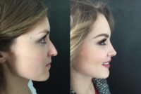 25-34 year old woman treated with Rhinoplasty