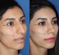 25-34 year old woman treated with Rhinoplasty