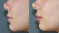 25-34 year old woman treated with Lip Fillers