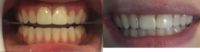 25-34 year old woman treated with Zoom Whitening