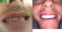 30 year old man treated with 10 Porcelain Veneers