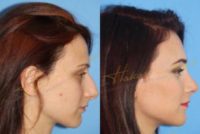 25-34 year old woman treated with Rhinoplasty