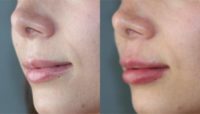 25-34 year old woman treated with Lip Fillers