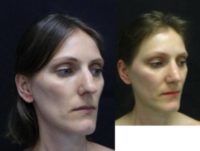 25-34 year old woman treated with Revision Rhinoplasty