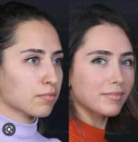 25-34 year old woman treated with Rhinoplasty