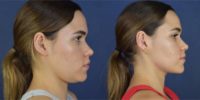 25-34 year old woman treated with Neck Lift, Chin Liposuction, Vaser Liposuction, Buccal Fat Removal