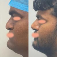 25-34 year old man treated with Cleft Rhinoplasty
