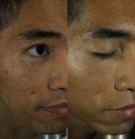 25-34 year old man treated with Microneedling