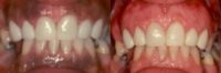 25-34 year old woman treated with Gum Lift