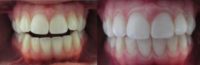 25-34 year old woman treated with Invisalign