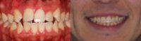 25-34 year old man treated with Braces