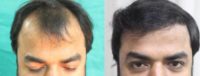 32 year old man treated with Hair Transplant