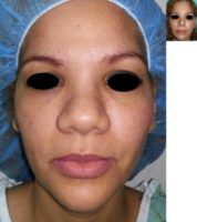 33 year old female treated with open Rhinoplasty