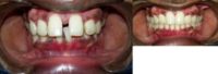 25-34 year old man treated with Invisalign