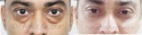 25-34 year old man treated with Eyelid Surgery
