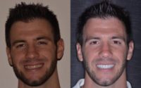 25-34 year old man treated with Smile Makeover