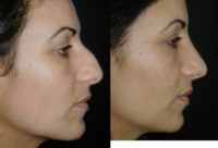 25-34 year old woman treated with Rhinoplasty