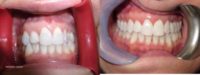 25-34 year old woman treated with Invisalign