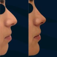 35-44 year old man treated with Rhinoplasty